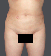 Patient # 96712 After Photo # 2