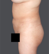 Patient # 96712 After Photo # 4