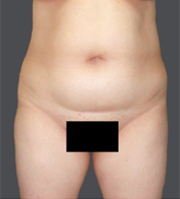 Patient # 96712 Before Photo # 1