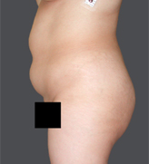 Patient # 96712 Before Photo # 3