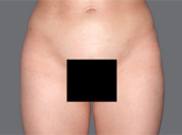 Patient # 57130 After Photo # 2