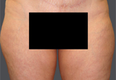 Patient # 78606 Before Photo # 1