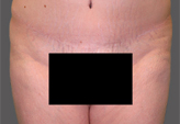 Patient # 88781 After Photo # 2