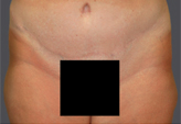 Patient # 54021 After Photo # 2