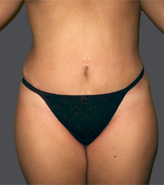 Patient # 14879 After Photo # 2