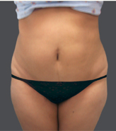 Patient # 14879 Before Photo # 1