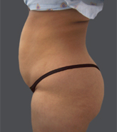 Patient # 14879 Before Photo # 3