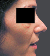 Patient # 97675 After Photo # 2