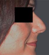 Patient # 97675 Before Photo # 1