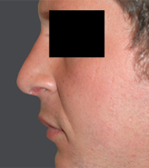 Patient # 80085 After Photo # 2