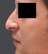 Patient # 80085 Before Photo # 1