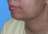 Patient # 25452 Before Photo # 1