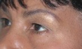 Patient # 14310 After Photo # 2