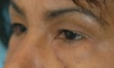 Patient # 14310 Before Photo # 1