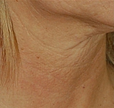 Patient # 50710 Before Photo # 1