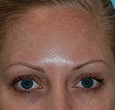 Patient # 72772 Before Photo # 1