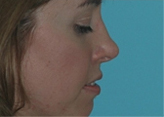 Patient # 76726 After Photo # 2