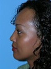 Patient # 69042 After Photo # 4