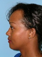 Patient # 69042 Before Photo # 3