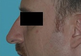 Patient # 88282 Before Photo # 1