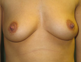 Patient # 34139 Before Photo # 1