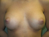 Patient # 39282 After Photo # 2