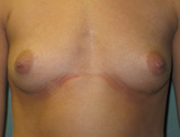 Patient # 39282 Before Photo # 1