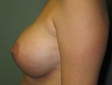 Patient # 47065 After Photo # 4
