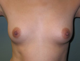 Patient # 47065 Before Photo # 1