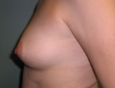 Patient # 47065 Before Photo # 3