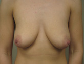 Patient # 90888 Before Photo # 1