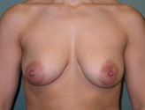 Patient # 38128 Before Photo # 1
