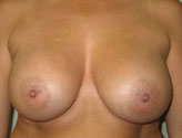 Patient # 15487 After Photo # 2