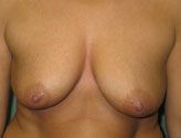 Patient # 15487 Before Photo # 1