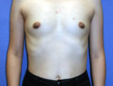 Patient # 33122 Before Photo # 1