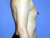 Patient # 33122 Before Photo # 3