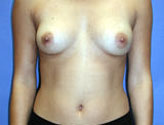 Patient # 29441 Before Photo # 1