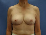Patient # 83460 After Photo # 2