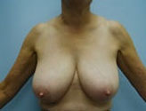 Patient # 83460 Before Photo # 1