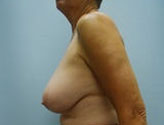 Patient # 83460 Before Photo # 3