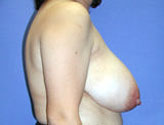 Patient # 52280 Before Photo # 3