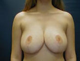 Patient # 60608 After Photo # 2