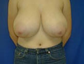 Patient # 60608 Before Photo # 1