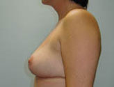 Patient # 11904 After Photo # 4