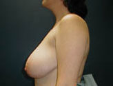 Patient # 11904 Before Photo # 3