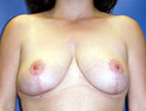 Patient # 78540 After Photo # 2
