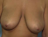 Patient # 11528 Before Photo # 1