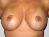 Patient # 61273 After Photo # 2