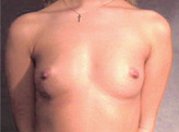 Patient # 84855 Before Photo # 1