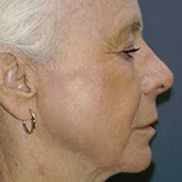 Patient # 20335 After Photo # 2